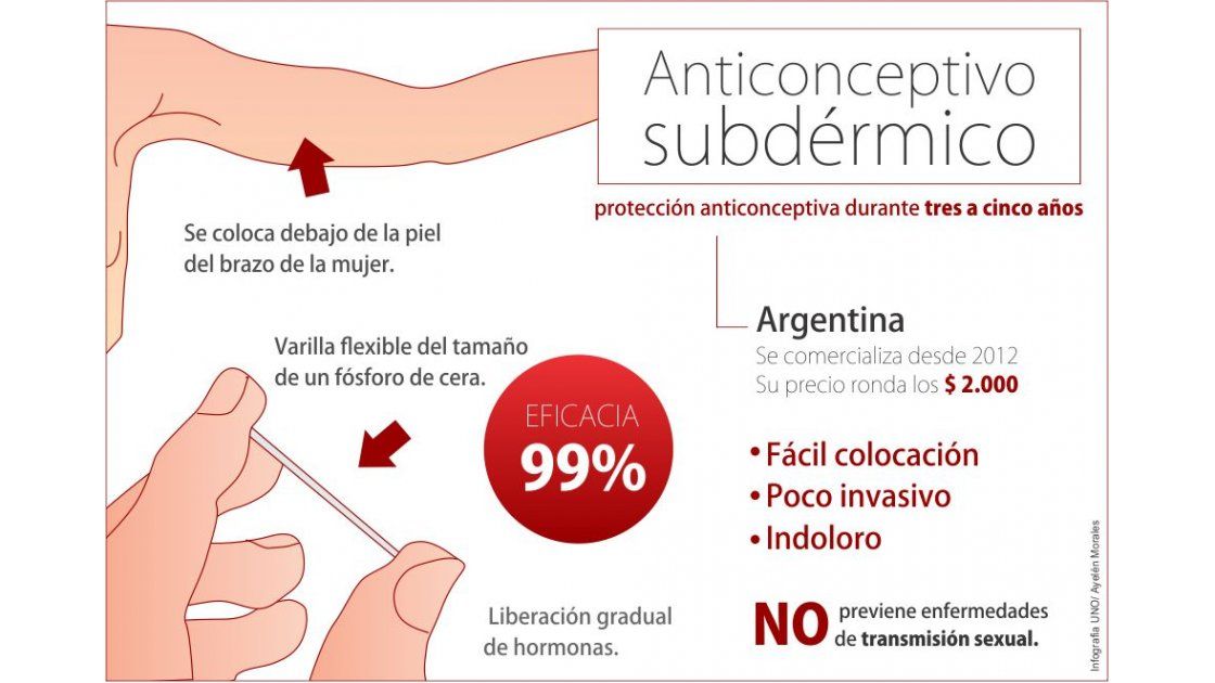 Incorporan un anticonceptivo subdérmico a los métodos gratuitos