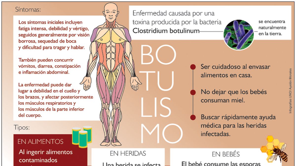 Botulismo la importancia de identificar los primeros síntomas