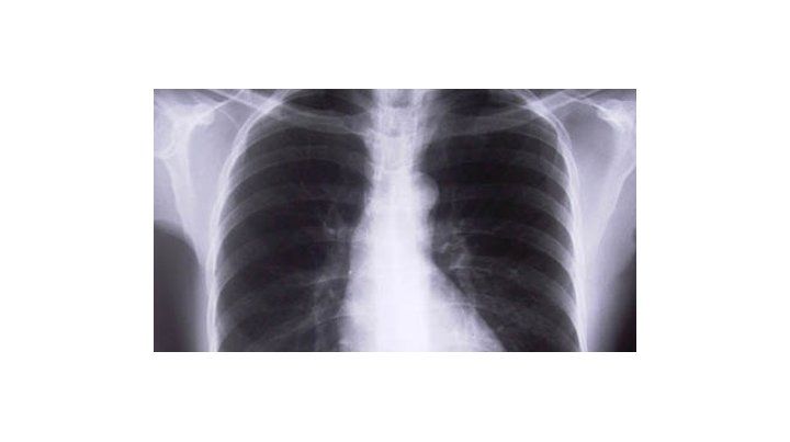 Descubren un posible tratamiento para la fibrosis pulmonar