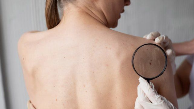 Melanoma: advierten sobre el aumento de casos