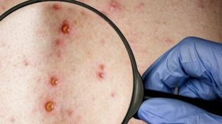 Viruela del mono: expertos deciden si se declara el nivel de alerta máxima
