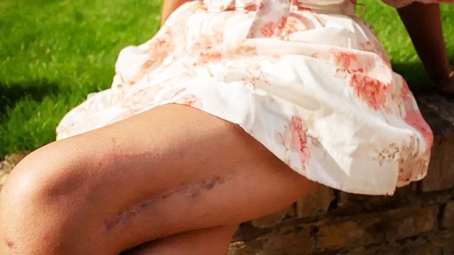 El alargamiento de piernas es un procedimiento poco común. Elaine Foo se sometió a esta operación en Londres. La dismorfia corporal y sus consecuencias&nbsp; 