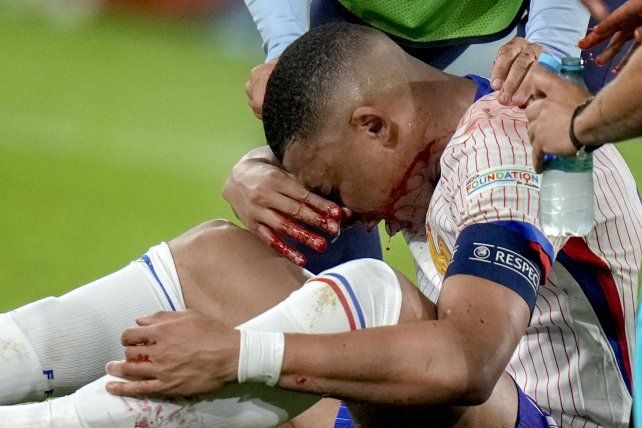 Mbappé se fracturó la nariz pero no será intervenido quirúrgicamente