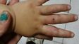 denunciaron que una nena de 3 anos fue desfigurada por su padrastro denunciaron que una nena de 3 anos fue desfigurada por su padrastro