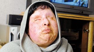 Una iran&iacute; desfigurada con &aacute;cido pidi&oacute; y obtuvo la aplicaci&oacute;n del ojo por ojo