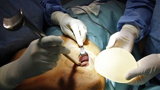 Alarma mundial por implantes mamarios franceses que estallan