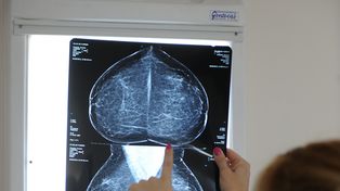 La mamografía es una exploración diagnóstica de imagen por rayos X de la glándula mamaria. Una práctica clave en la prevención.