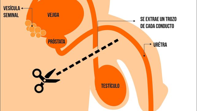 La vasectomía, entre el mito y el rol del varón en materia reproductiva