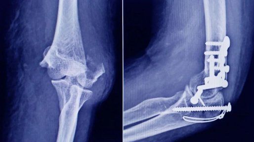 Anmat advierte que un tornillo utilizado en cirugías traumatológicas es falso