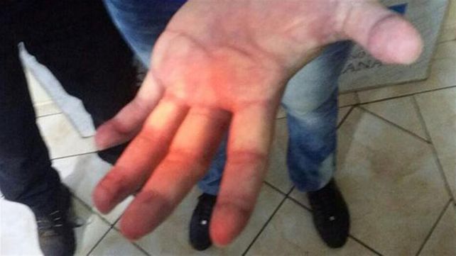 Así están las manos de Ibar Pérez Corradi: habría intentado borrarse las huellas digitales