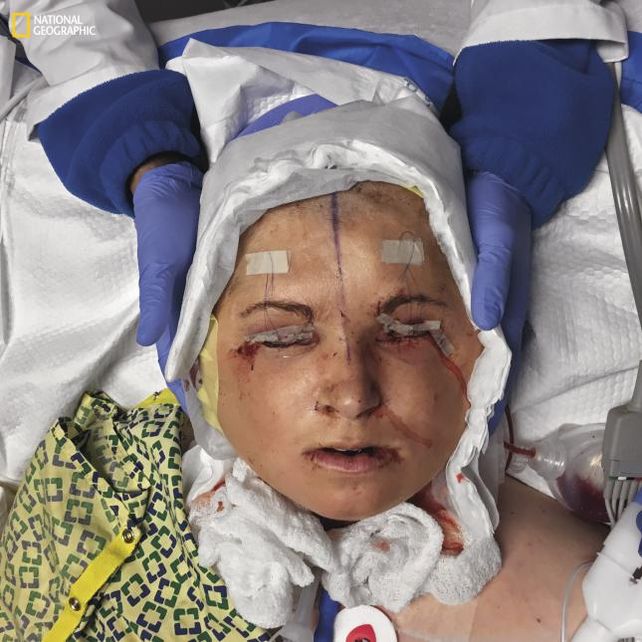 La historia de la chica que recibió un trasplante total de cara