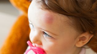 Golpes en la cabeza en la infancia: cómo actuar y cuándo consultar al médico