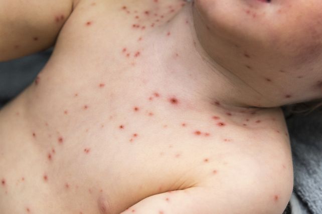 Alerta epidemiológico por dos casos autóctonos de sarampión
