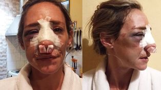 Ella perdonó a su ex, el volvió a su casa y le desfiguró la cara
