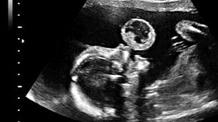 Pionera cirugía intrauterina salva la vida de una niña