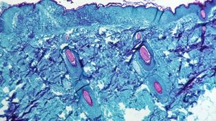 Descubren cuál es el mecanismo que usa el virus de la viruela del mono. Qué implica para el control de la infección que ya tiene más de 23.000 casos en el mundo