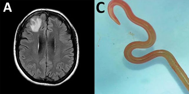 La resonancia magnética del cerebro mostraba extrañas manchas. A la derecha