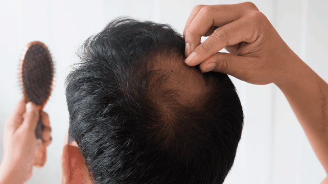 Las consultas por caída del pelo aumentaron entre los jóvenes
