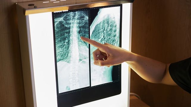 Radiografía de zona toráxica. Con la edad