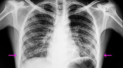 Neumonía bilateral en Tucumán: qué se sabe de la infección