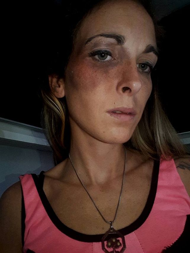 Rastros de la golpiza. Así le quedó el pómulo derecho a la madre atacada a golpes.