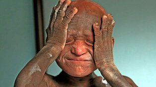 Un niño nepalí sufre una extraña enfermedad que lo transforma en piedra