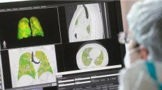 imagenes: el coronavirus deja peor los pulmones que fumar durante toda una vida imagenes: el coronavirus deja peor los pulmones que fumar durante toda una vida