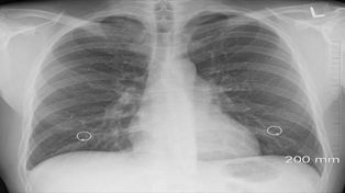 Le diagnosticaron tuberculosis, pero meses después se dieron cuenta que se había tragado un preservativo