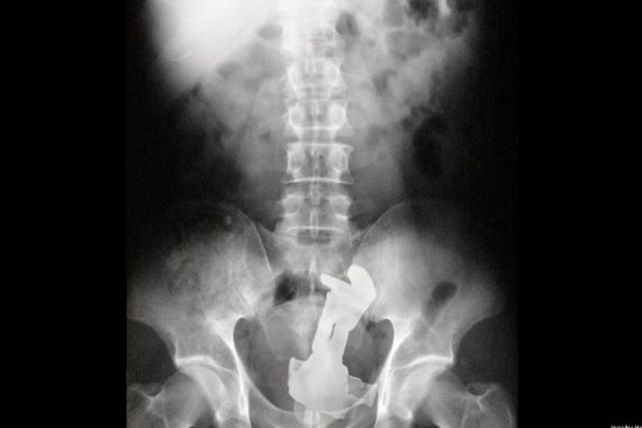 Atorados, las 100 radiografías más insólitas