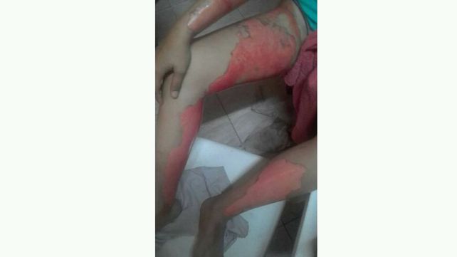 Un boxeador roció con nafta y prendió fuego a su novia