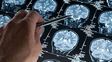 Análisis de sangre pueden detectar el Alzheimer tres años antes de que se desate