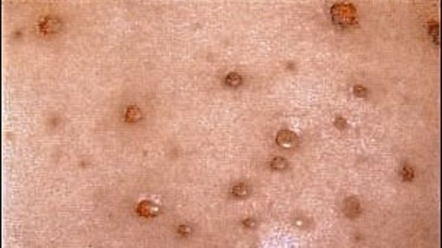 Los pediatras consideran que es importante la segunda dosis de vacuna contra la varicela