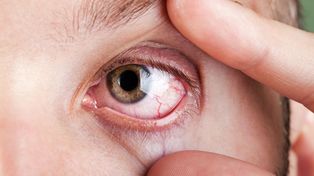 Un problema habitual. El ojo seco se caracteriza por enrojecimiento, picazón y sensación de tener arenilla.&nbsp;