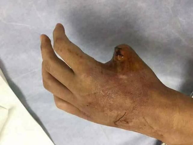 Esto pasa si no tratás a tiempo una mordedura de serpiente venenosa