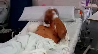 Un delincuente ingresó a robar a una casa, fue atacado por un pitbull y le amputaron un brazo