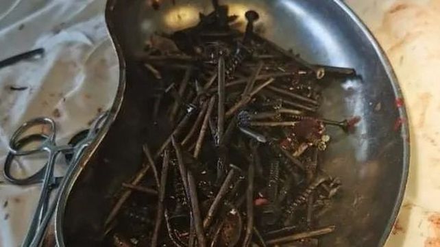A un hombre le extrajeron más de un kilo de clavos y tornillos del estómago