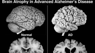 Descubren cómo predecir el Alzheimer con un simple test de sangre
