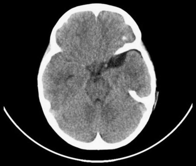 hematoma subdural que une las venas