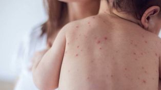 Mamá antivacunas les transmitió el sarampión a sus hijos