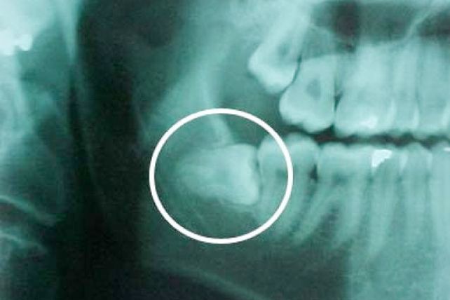 Muela del juicio: ¿hay que sacársela o no?