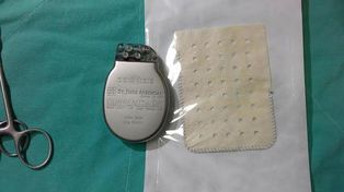 Se realizó en Rosario una intervención novedosa para cardiodefibrilador implantable