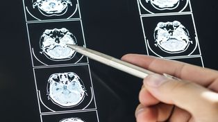Este lunes se conmemora el Día Internacional de la Epilepsia para concientizar sobre esta condición médica que afecta a aproximadamente 50 millones de personas de todas las edades y sexos, según datos de la Organización Mundial de la Salud (OMS).