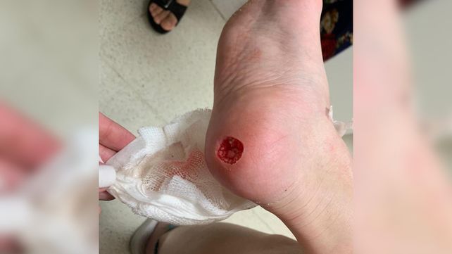 Así le quedó el talón tras ser atacada por palometas