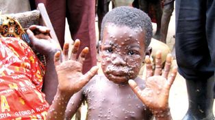 Un niño africano muestra el exantema característico de la enfermedad distribuido por todo su cuerpo.
