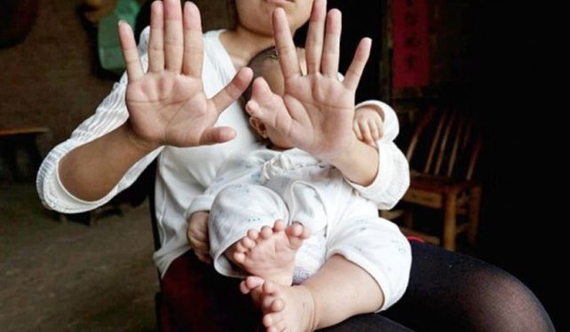 Asombro por el bebé chino que tiene 31 dedos