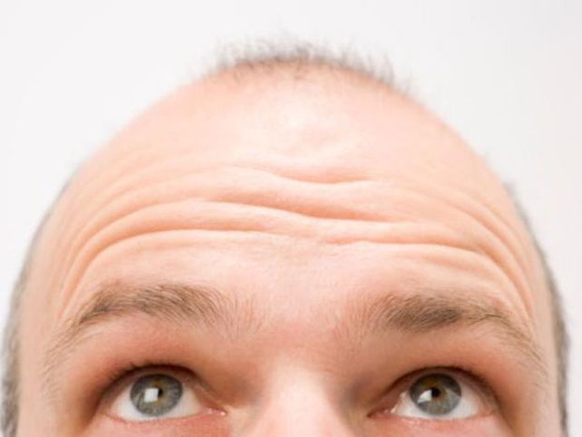 Un medicamento para la artritis pone fin a la alopecia