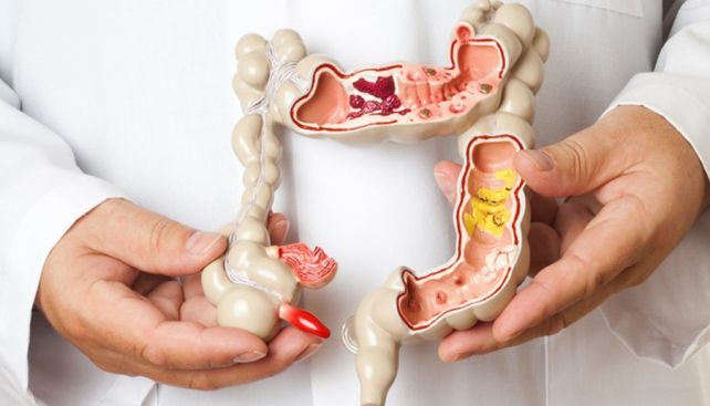 El cáncer de colon se detecta en hombres y mujeres