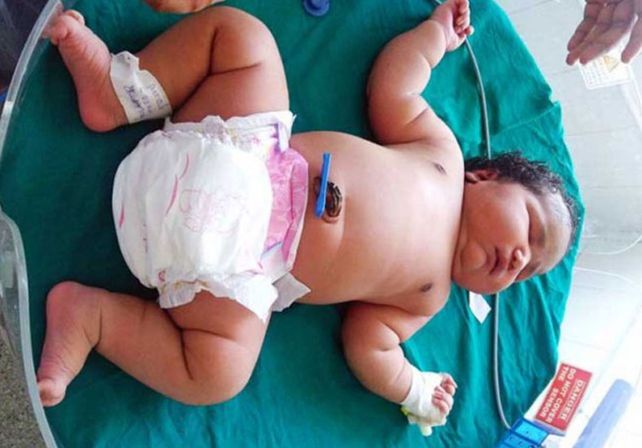 El bebé más grande del mundo nació en la India con 7 kilos de peso y por cesárea