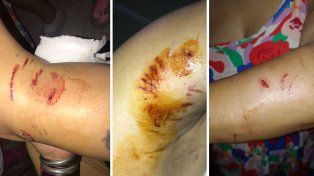 Un pitbull y otro perro atacaron a una mujer en Loyola Sur y le arrancaron un pedazo del pecho