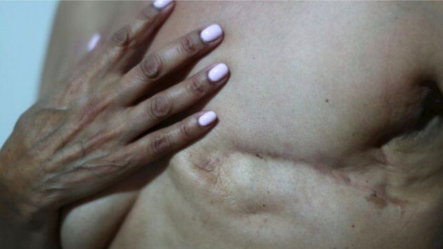 Tatuarán y reconstruirán las areolas mamarias de las personas que padecieron cáncer de mama